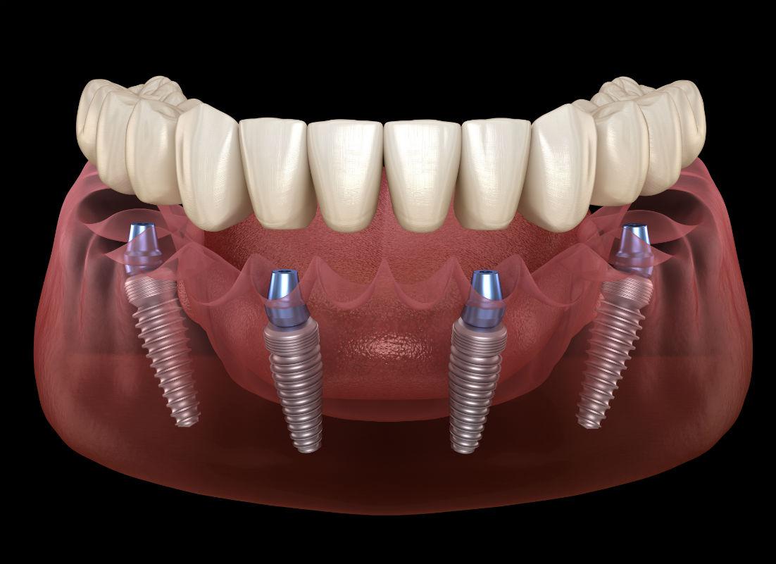 All On 4 Implants Lake Ridge, VA