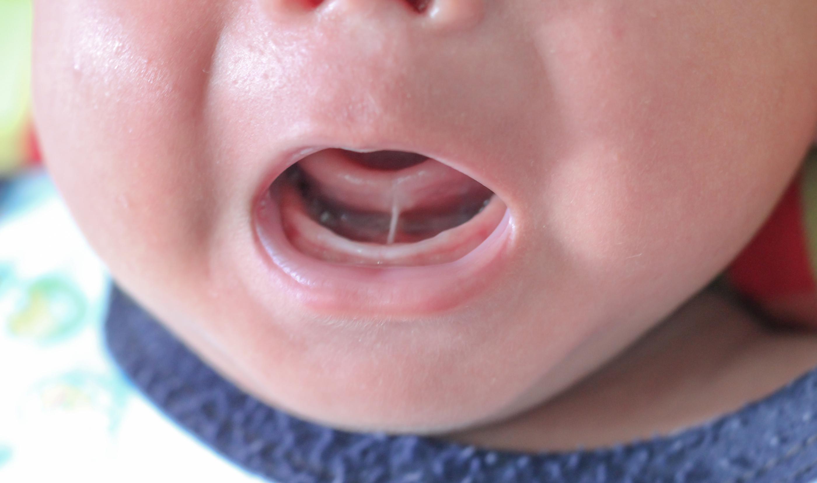 Frenectomy Northern Virginia, VA