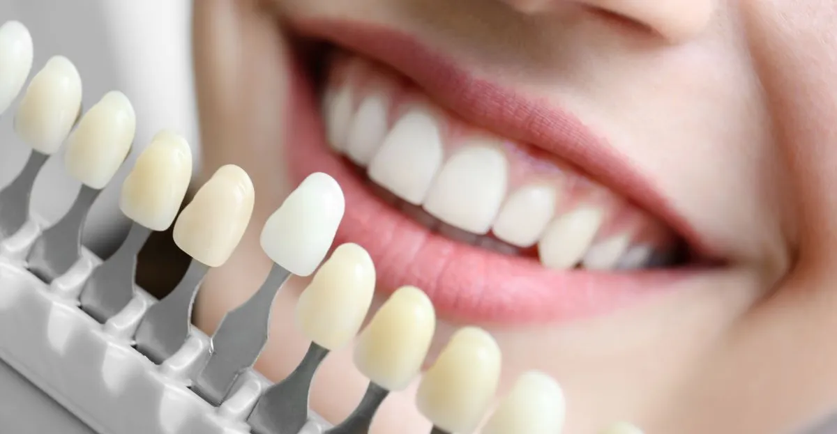 In-Office Whitening vs. Custom Take-Home Trays